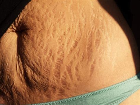Girls with stretch marks porn pics.  Fund your creativity by creating subscriptio...
