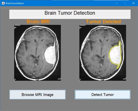 GitHub surajmane24/BrainTumorDetection