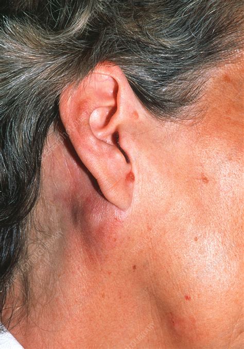 Glands behind ears swollen pictures. The following lymph node locations are the easiest to palpate (i.e. feel): Submandibular lymph nodes —located on either side of the lower jaw where it meets the neck. Prescapular lymph nodes (i.e. superficial cervical lymph nodes) —found in front of the shoulder blade where the neck and shoulder meet. 