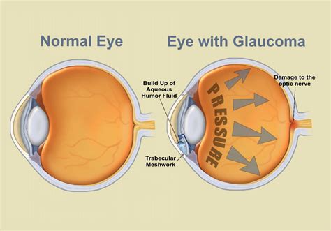 Glaucoma - Tandon Eye Hospital