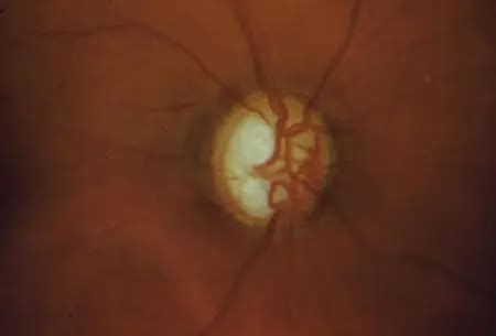 Glaucoma definition aao