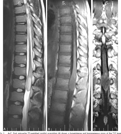 Glioblastoma Multiforme Involving Conus Medullaris in a Child