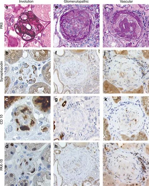 Glomerular involution in children with ... - Kidney International