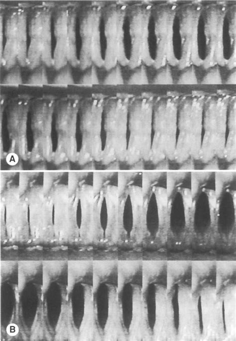 Glottal Area Waveform Analysis of Benign Vocal Fold Lesions …