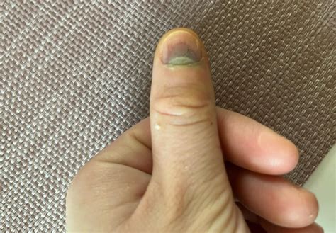 Gnoj ispod nokta na ruci.  Featuring BlackBerry Technical Help, How-To Guide's...