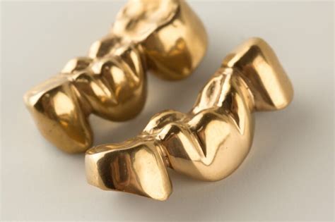 Gold Crowns Bridge Dental