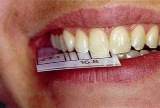 Golden Proportions in Teeth Golden Mean Gauge