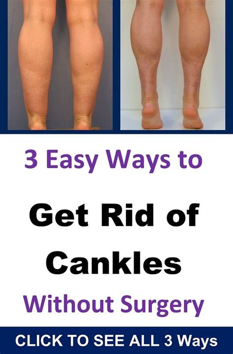 Got Cankles? How to Redefine Your Calves and Ankles