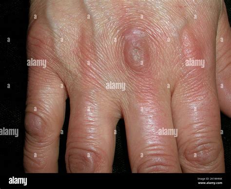 Gottron Papules Mimicking Dermatomyositis: An Unusual …