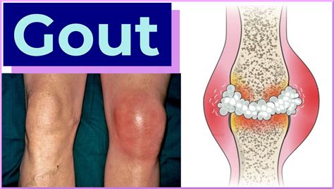 Gout Gout
