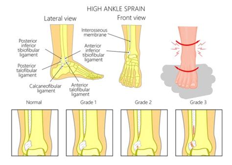 Grade 3 Ankle Sprain Recovery Process and Time