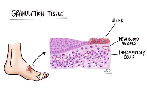 Granulation tissue - Wikipedia