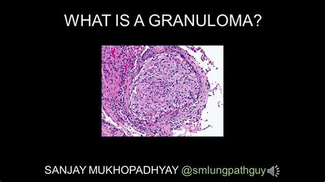 Granuloma: What does it mean? - Mayo Clinic