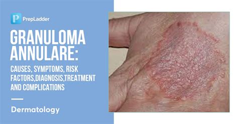 Granuloma Annulare: Causes and Treatments - Dermatology …