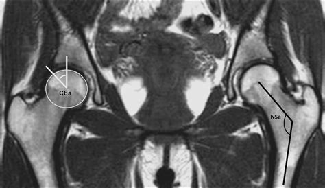 Greater trochanter pain syndrome: A descriptive MR imaging study