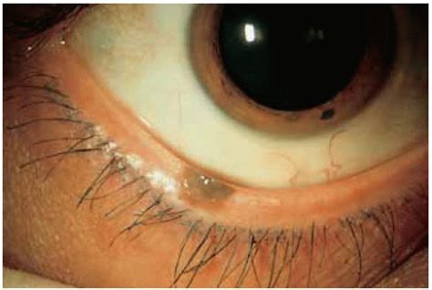 Grey Inside Eyelid Pigmentation