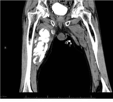 Groin and thigh pain following radical prostatectomy