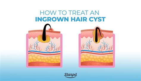 Groin ingrown hair cyst. Pilonidal cysts form in the skin near the tailbone or lower back, and they sometimes contain ingrown hair. These cysts can grow in clusters, which sometimes creates a hole or cavity in the skin. 