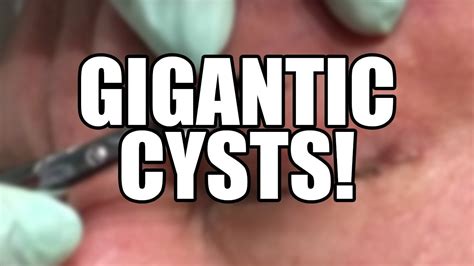 Grossest pimple popping. Big clogged pore contents expressed! Small cyst. Big squeeze. Cyst pop. Close up poredirt! Juicy blackhead/cyst. MrPopZit. 