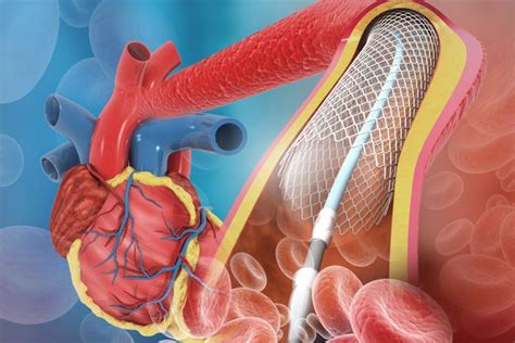 Guía de bolsillo para el cateterismo cardíaco diagnóstico. - Designing control loops for linear and switching power supplies a tutorial guide.