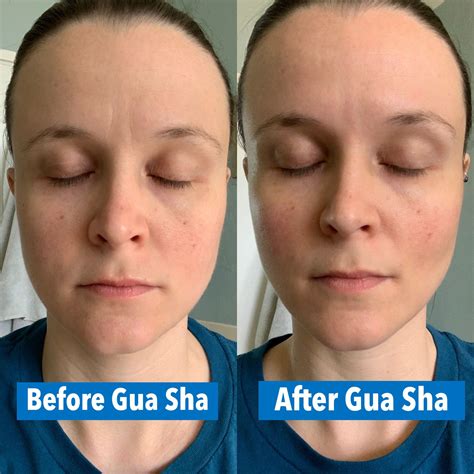 Gua Sha Before And After Pictures & Videos - Drug Genius