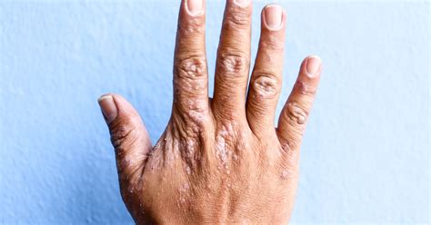 Guide To Treating Dyshidrotic Eczema - HealthPrep.com