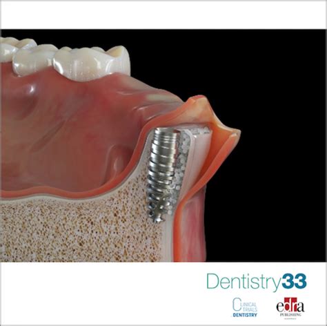 Guided bone regeneration in implant dentistry. - John deere lx172 lawn tractor oem service manual.