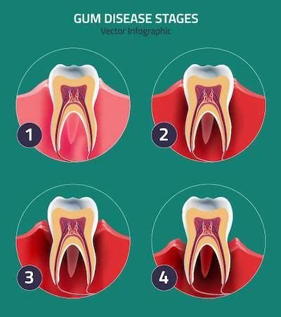 Gum Disease Treatment Orlando Desai Dental