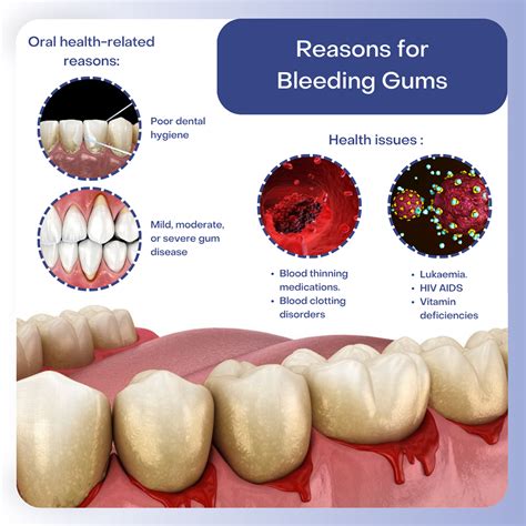 Gum bleeds in one spot when flossing
