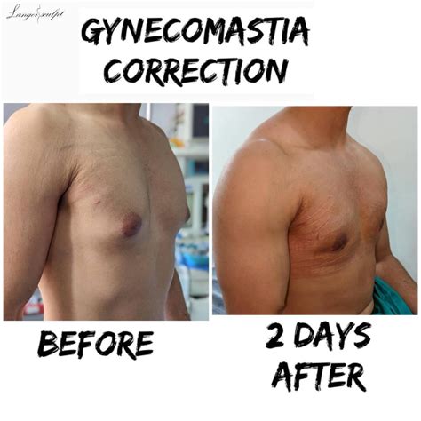 Gynaecomastia - PCH