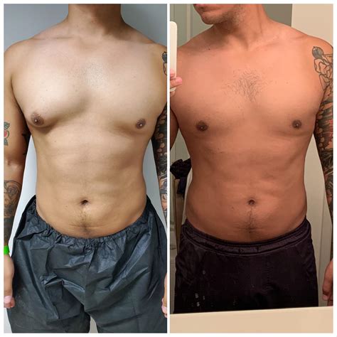 Gynecomastia reddit. Gynecomastia is abnormal breast enlargement of males, whether that be glandular tissue, fat, or both. This subreddit is for questions and discussion related to gynecomastia. 
