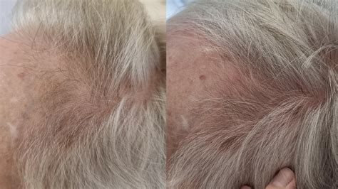 Håravfall kvinna behandling