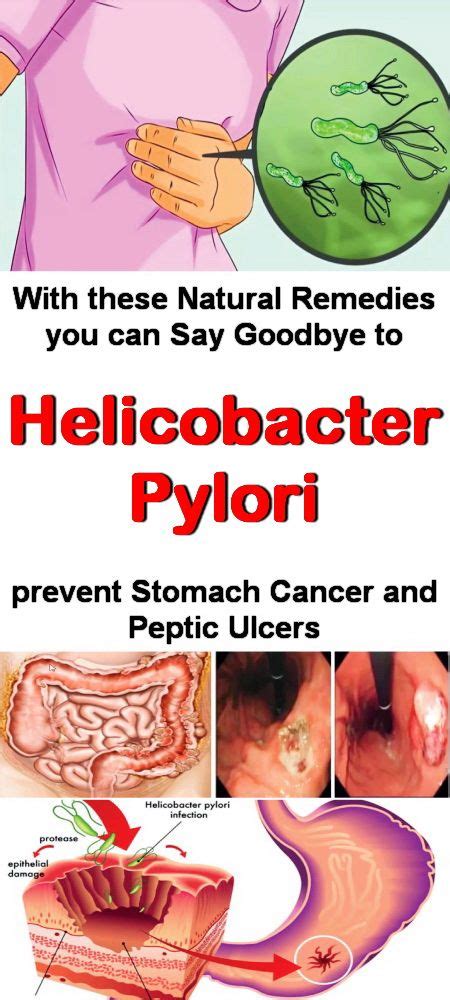 H Pylori, antibiotic or natural treatment? : r/GERD - Reddit