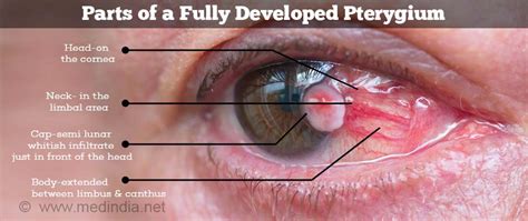 H11.053 - Peripheral pterygium, progressive, bilateral - ICD List