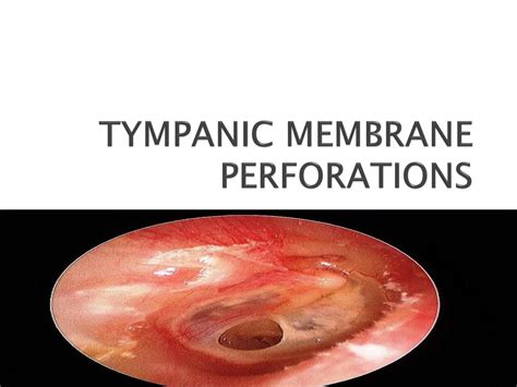 H72.90 - Unspecified perforation of tympanic membrane, …