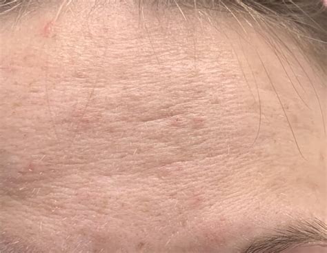 Hair loss at age 20 : Insecure and Looking for Advice - balustradellc