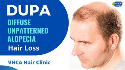 Hair Loss Diffuse Thinning Treatment Options: The DPA vs. DUPA ... - balustradellc
