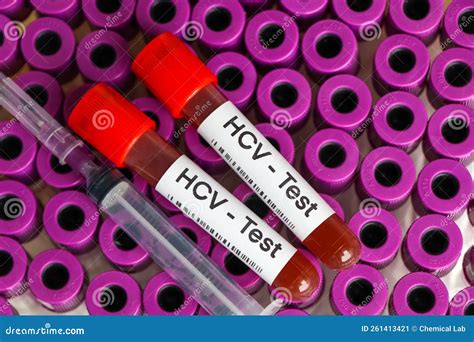 HCV Test To Look for Abnormalities from Blood Stock Image Image of