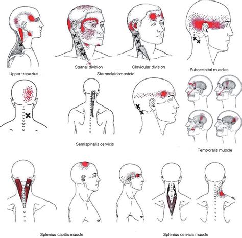 Headache Trigger Points & Self-Massage Techniques - balustradellc