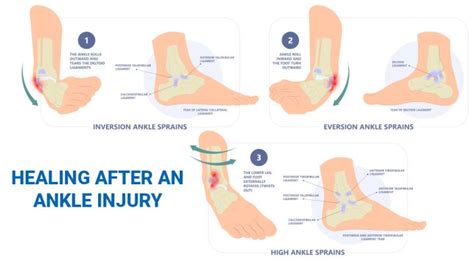 Heal Ankle Sprain Fast: Simple Steps - balustradellc