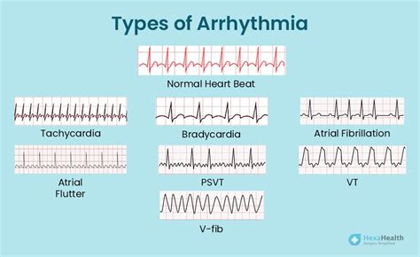 Heart arrhythmia - Symptoms and causes - Mayo Clinic - balustradellc