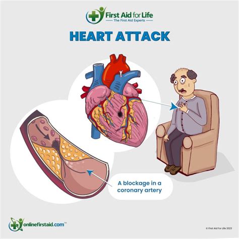 Heart attack - Symptoms & causes - Mayo Clinic - balustradellc