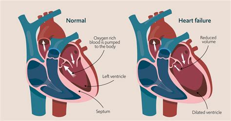 Heart failure - Diagnosis and treatment - Mayo Clinic - balustradellc