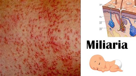 Heat rash (Miliaria): Images, Causes, and Treatment - balustradellc