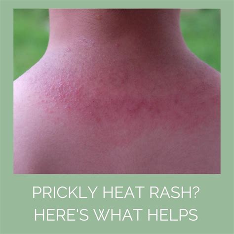 Heat rash (prickly heat) - NHS - balustradellc