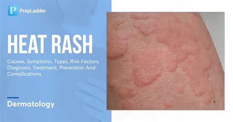 Heat Rash - 9 Ways To Get Rid Of Heat Rash And Prickly Heat - balustradellc
