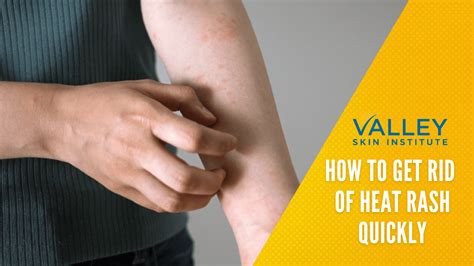 Heat Rash Skin Irritation Treatment: How to Get Rid of It - balustradellc