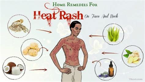 Heat Rash Treatment: 9 Home Remedies - Business … - balustradellc