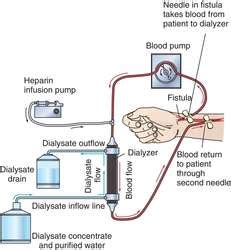 HEMODIALYSIS English meaning - Cambridge Dictionary