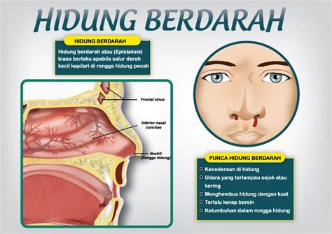 Hidung Sebelah Kiri Berdarah - balustradellc